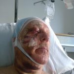 Christer Svensson lider ännu av sviterna efter den otäcka skjutolyckan i somras.  Foto: Privat