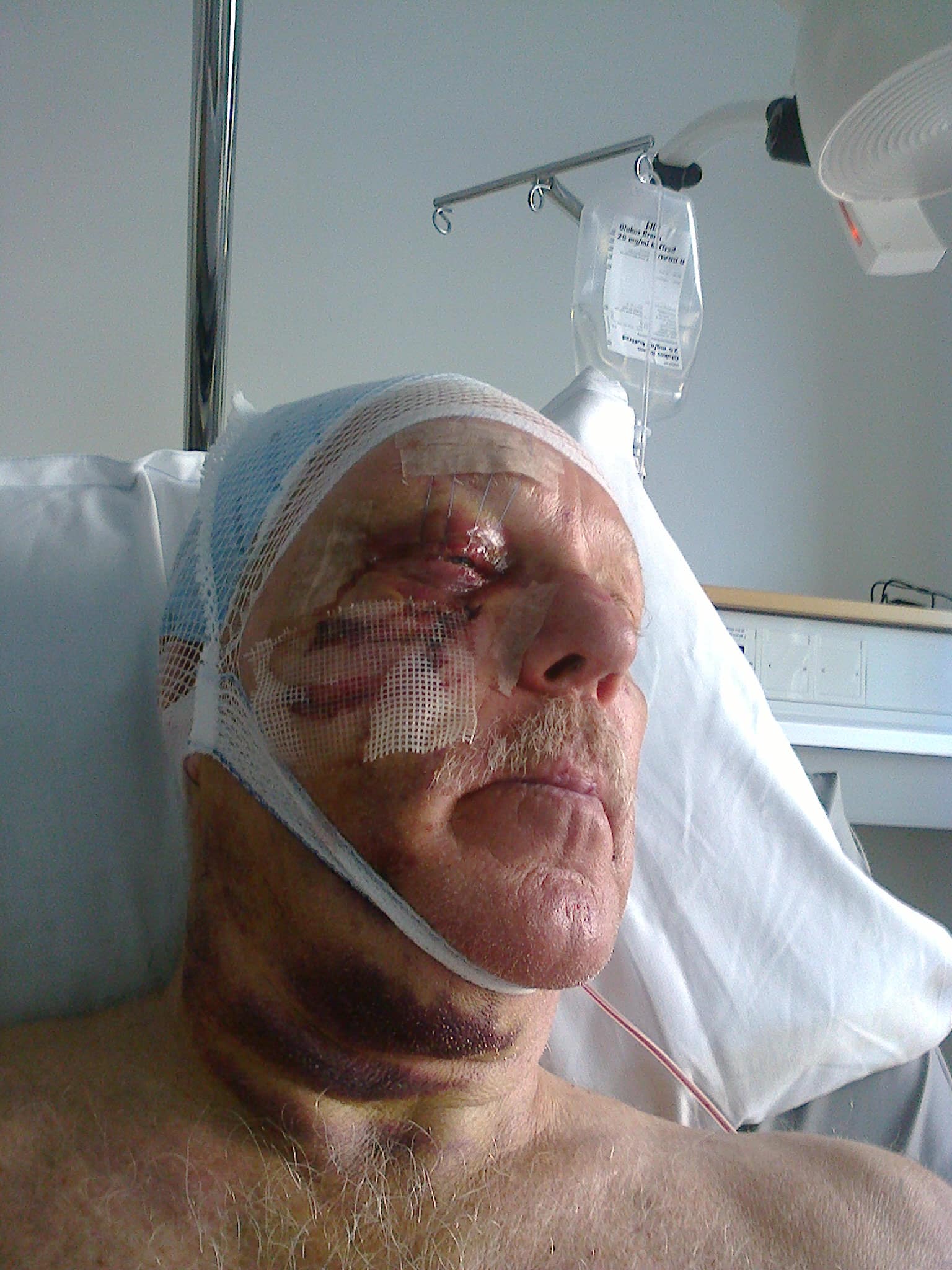 Christer Svensson lider ännu av sviterna efter den otäcka skjutolyckan i somras. Foto: Privat