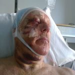 Christer Svensson var nära att dö vid den  otäcka skjutolyckan förra sommaren. Foto: Privat