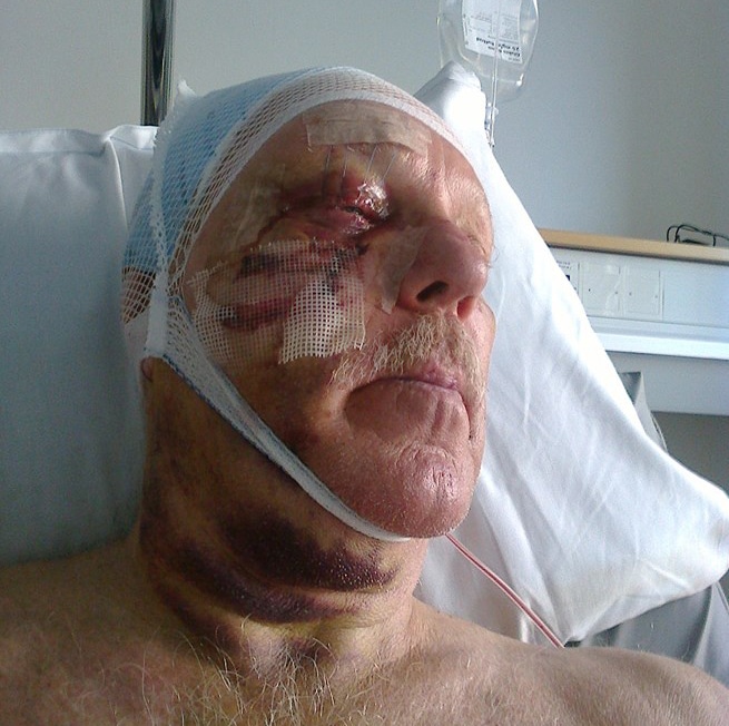 Christer Svensson skadades svårt vid en skjutlyckan förra sommaren. Han tror inte att olyckan hade kunnat inträffa med vilket vapen som helst. Foto: Privat